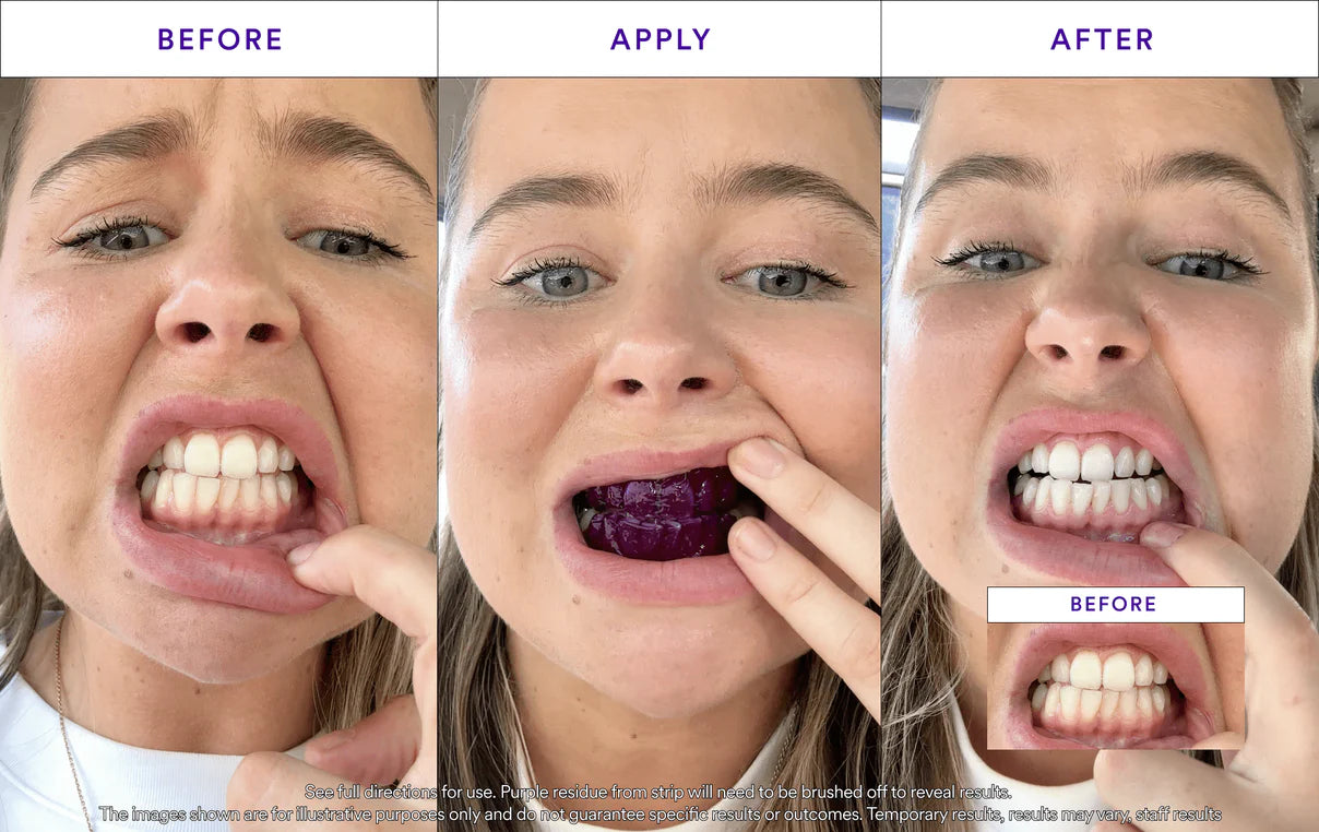 Teeth Whitening Strips