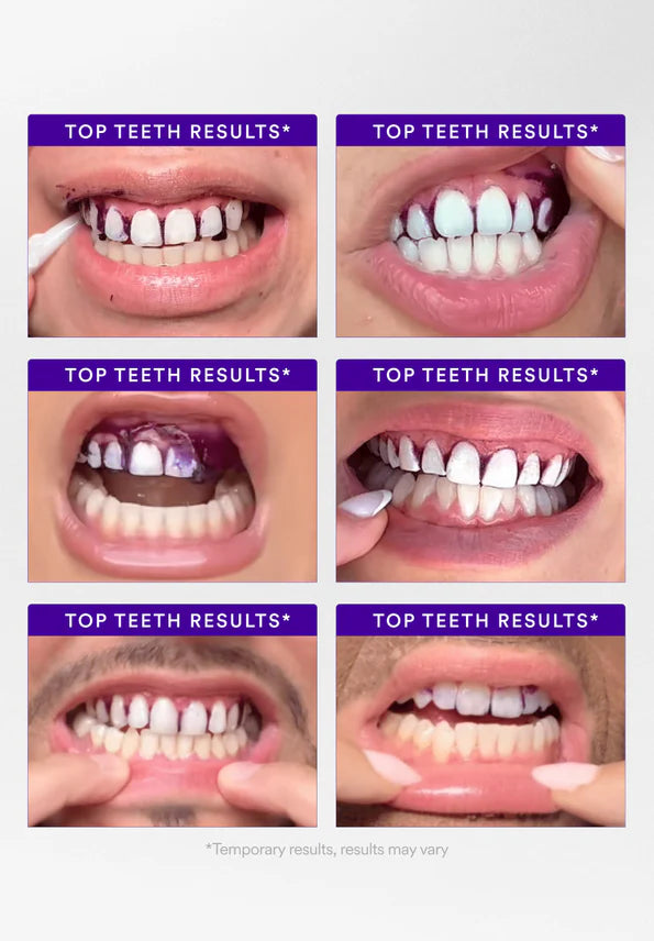 Teeth Whitening Strips